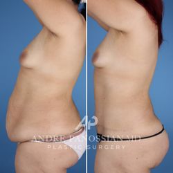Andre Panossian, MD - Tummy tuck