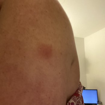 Hyatt Regency New Brunswick - Bed bug bite - Hotels Near Me - New Brunswick, New Jersey Hyatt Regency New Brunswick - Bed bug bite - Hotels Near Me - New Brunswick, New Jersey