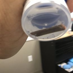 piece of wood removed from the bottom of my right foot piece of wood removed from the bottom of my right foot