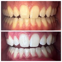 Bright Bites by Sadie, RDH - Organic LED teeth whitening