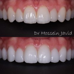 Toothopia Dental - Experience the magic of perfect veneers! After two attempts with other Beverly Hills dentists, this patient chose Dr. J at Toothopia Dental,