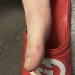 Shaved off skin (was bleeding before this)