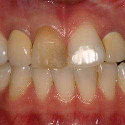Yi Jay - Kensington Dental Designs - Before