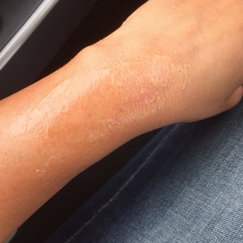Aisha's Salon & Spa - Initially you cud see the white spots as my skin was peeled off - Hair Salons Near Me - Houston, Texas