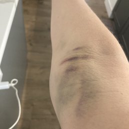 After three days. Still pain and slight swelling.