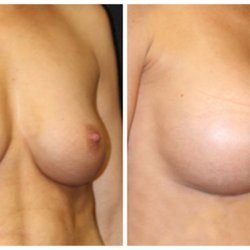 Kris M Reddy, MD, FACS- Plastic Surgery Center - Natural looking Breast Augmentation (with Gel Implants) from $120/month (5 years). 0% financing and no credit check payment plans available.