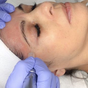 H.E.R. Dermaplane Bar - Microneedling treatment - Skin Care Near Me - Centereach, New York
