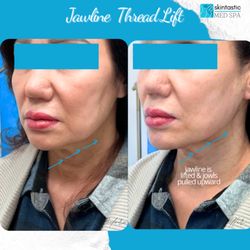 Skintastic Med Spa - Before & After of PDO threadlift of jawline and nasolabial folds