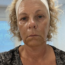 Illume Medical Spa - Before treatment