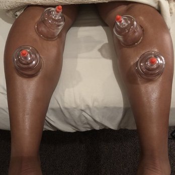 Mobile PT Clinic - Cupping therapy - Physical Therapy Near Me