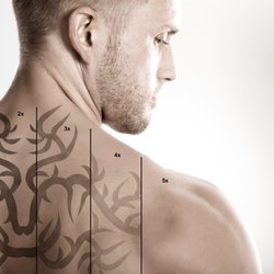 Infinite Allure - We are the only MedSpa with the fastest Laser Tattoo removal on the market. Less pain, no downtime.