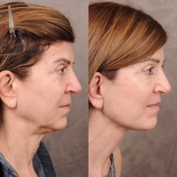 Ben Talei, MD - AuraLyft™, Cupid Lift®, Upper Blepharoplasty, and Ptosis Repair