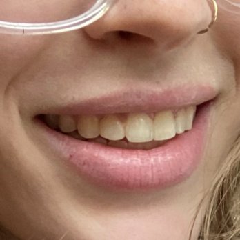 Kotch Dental - When cavity started to form - General Dentistry Near Me - Pembroke Pines, Florida