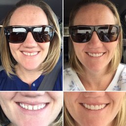 6 new veneers 6 new veneers