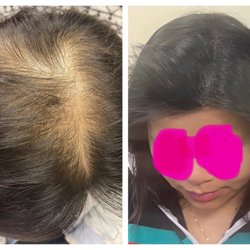 Semper Hair - Hair Loss is devastating for women, but permanent concealment is life-changing