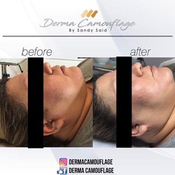 Before and after BB GLOW TREATMENT