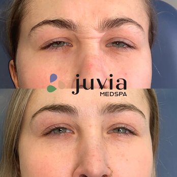 Juvia Med Spa - Botox makes the wrinkles to away. - Medical Spas Near Me - Colleyville, Texas Juvia Med Spa - Botox makes the wrinkles to away. - Medical Spas Near Me - Colleyville, Texas
