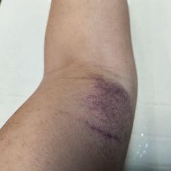 Quest Diagnostics - My arm all bruised the day after drawing blood