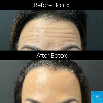 Botox Treatments - Botox Treatments at Healthy Solutions Medspa

Enhance your natural beauty with expertly performed Botox treatments at Healthy Solutions Medspa, a leading aesthetic practice recognized in the top 5% of Botox and Filler providers nationwide.

Our experienced team of medical professionals that specialize in creating natural, balanced, and beautiful results whether you’re looking to add volume, define your lip shape, or smooth fine lines.

Using only FDA-approved fillers and advanced injection techniques, we tailor every treatment to your unique features and goals for subtle, confidence-boosting results.

Healthy Solutions Medspa proudly serves patients from two convenient locations in Doylestown and Warminster, Ivyland, Furlong, Pennsylvania, offering a full range of non-surgical treatments for facial rejuvenation, skin health, and body contouring.

✨ Why patients love us:
Top 5% Botox & Filler provider in the U.S.
Expert, experienced injectors
Personalized consultations and treatment plans
Natural-looking, long-lasting results

📍 Locations:
Doylestown, PA
Furlong, PA

💉 Book your Botox consultation or treatment today and discover why Healthy Solutions Medspa is Bucks County’s most trusted destination for injectables and aesthetic care.