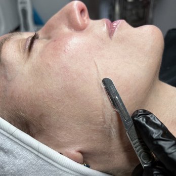 Beautissima - Dermaplaning - Skin Care Near Me - Bothell, Washington Beautissima - Dermaplaning - Skin Care Near Me - Bothell, Washington