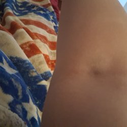 Labcorp - Bruise from the bloodwork