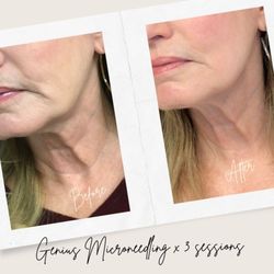 Juvly Aesthetics