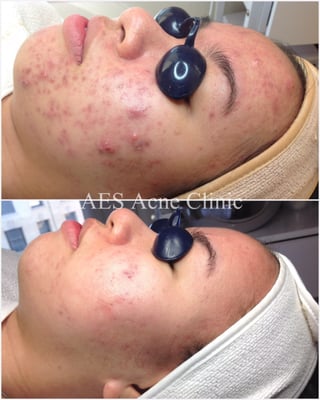 AES Acne Clinic by null