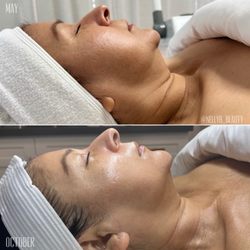 Nelly B Beauty Studio - Before and after DMK Enzyme Therapy for age management and brightening
