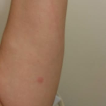 Holiday Motel - Bedbug bites on one arm. It should be noted that I didn't know it at the time, but I actually saw a bedbug in the motel bathroom. - Hotels Near Me - Bend, Oregon