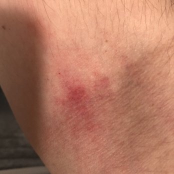 Labcorp - My arm is scraped from them rubbing the alcohol swab too hard - Laboratory Testing Near Me - Babylon, New York
