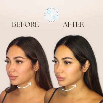 Optimal Plastic Surgery - lower face balancing with nurse jennie - Plastic Surgeons Near Me - Huntington Beach, California