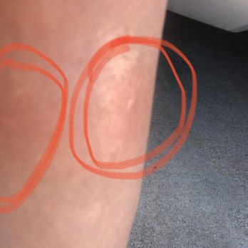 Ancient  Massage - Here's an up close look, the oval circle actually has 2 bites. - Massage Near Me - San Gabriel, California