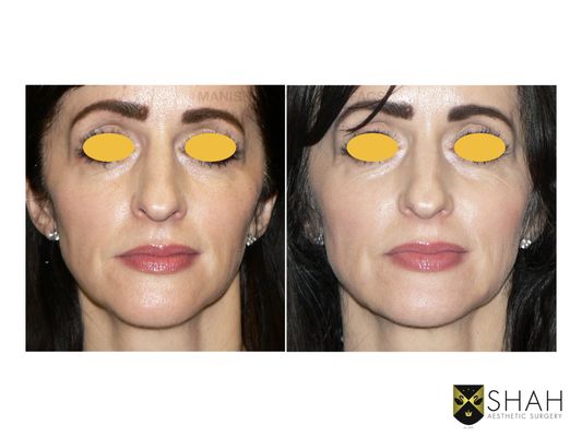 Shah Aesthetic Surgery - Rhinoplasty and Facelift Specialist by null
