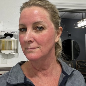 Tella Total Wellness - Before the lip filler, but after the micro needling. I didn't fill a thing. - Medical Spas Near Me - San Antonio, Texas Tella Total Wellness - Before the lip filler, but after the micro needling. I didn't fill a thing. - Medical Spas Near Me - San Antonio, Texas