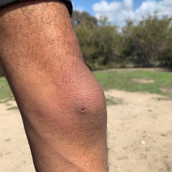 SIXTY Beverly Hills - Photo shows my spider bite I woke up with swollen elbow - Hotels Near Me - Beverly Hills, California SIXTY Beverly Hills - Photo shows my spider bite I woke up with swollen elbow - Hotels Near Me - Beverly Hills, California