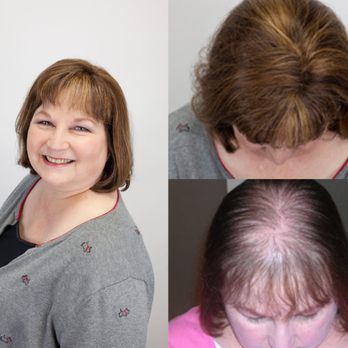 New England Associates - Hair Loss Centers Near Me - Wakefield, Massachusetts New England Associates - Hair Loss Centers Near Me - Wakefield, Massachusetts