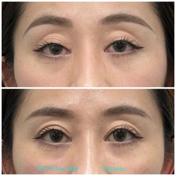 RSVP Med Spa - Upneeq before and after for low lying eyelids