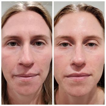 Nature's Touch SF - Bright and rejuvenate skin just after one session - Permanent Makeup Near Me - San Francisco, California Nature's Touch SF - Bright and rejuvenate skin just after one session - Permanent Makeup Near Me - San Francisco, California