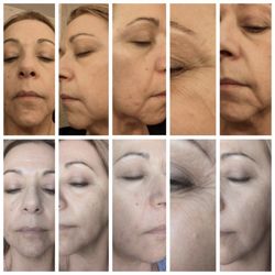 Faces From Nature Spa - Three months after starting our "Volume"Skincare Products. Notice the increase cheek volume and lifted mouth corners.