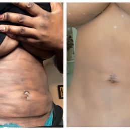 Stomach after 360 lipo Stomach after 360 lipo