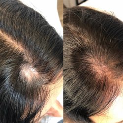Grace & Purity Medi Spa - Scalp pigmentation