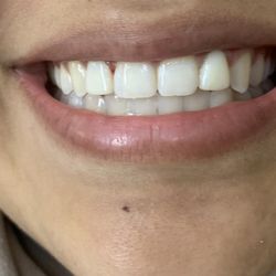Brantly Dental - My daughter after composite veneers