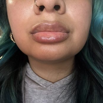 NakedMD - Right after getting lip filler full syringe of restylane-L - Medical Spas Near Me - Downey, California NakedMD - Right after getting lip filler full syringe of restylane-L - Medical Spas Near Me - Downey, California