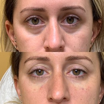 Silk Laser & Aesthetics Centre - Tear trough fillers - Medical Spas Near Me - Ft. Lauderdale, Florida Silk Laser & Aesthetics Centre - Tear trough fillers - Medical Spas Near Me - Ft. Lauderdale, Florida