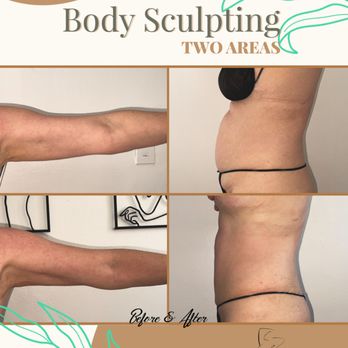 Body By Brenda - Before & After - Body Contouring Near Me - Los Angeles, California Body By Brenda - Before & After - Body Contouring Near Me - Los Angeles, California
