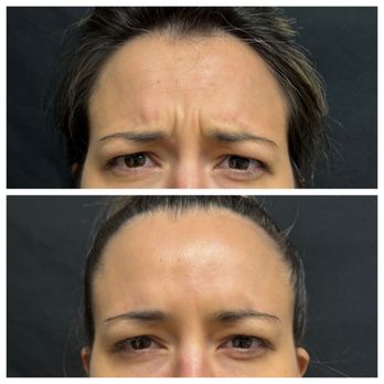 Phuong M Pham, MD - United Plastic Surgery - Only 5 Days Post Botox by Allergan. - Plastic Surgeons Near Me - Temecula, California