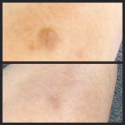 Medical Aesthetics Of Monroe - Spot treatment with ipl