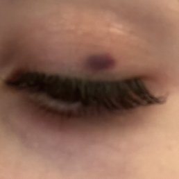 Close-up image of a closed eye with eyelash extensions, showing a small blemish above the eyelid, in a neutral setting.
