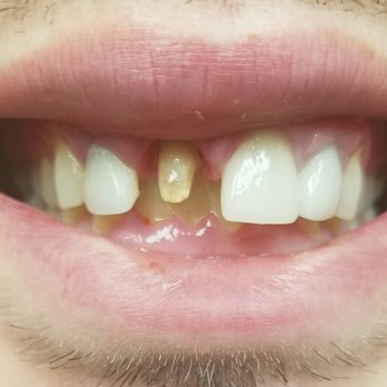 Lighthouse Dental - Before Emax porcelain crown- - Cosmetic Dentists Near Me - Vancouver, Washington Lighthouse Dental - Before Emax porcelain crown- - Cosmetic Dentists Near Me - Vancouver, Washington