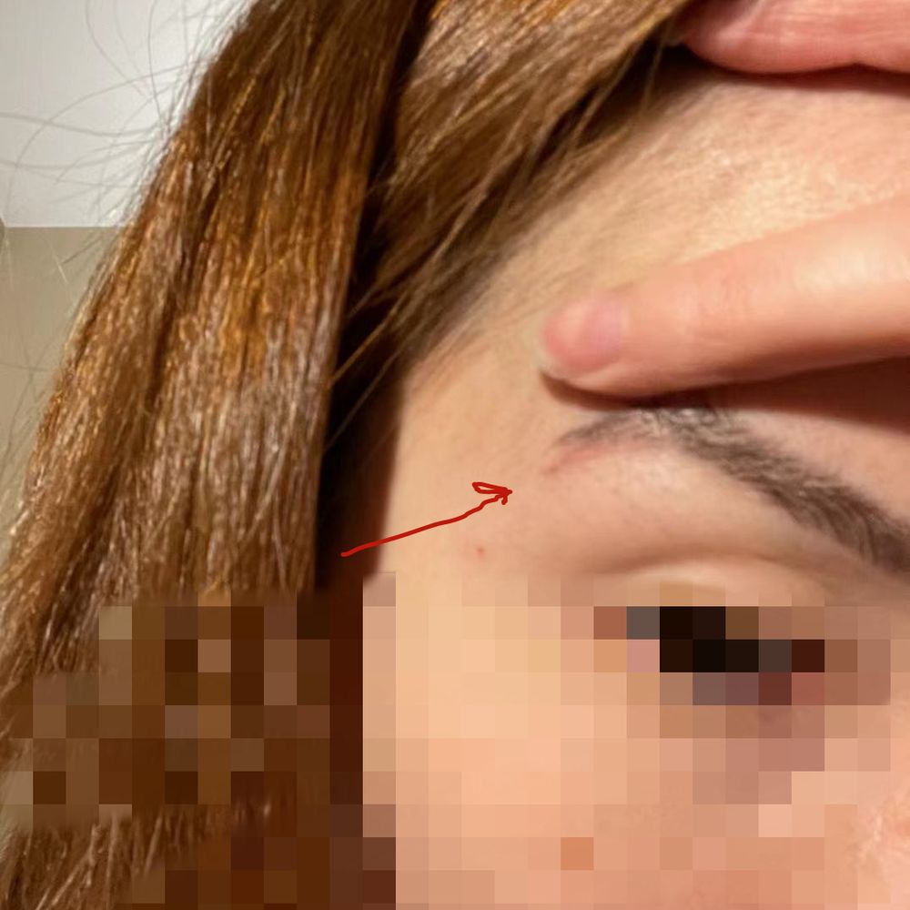 Arlington NOVA Laser & 3D Microblading - Cut Scar - Eyebrow Services Near Me - Arlington, Virginia Arlington NOVA Laser & 3D Microblading - Cut Scar - Eyebrow Services Near Me - Arlington, Virginia